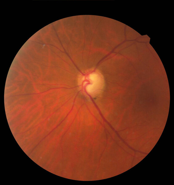 View inside human eye showing retina, optic nerve and macula. Health concept