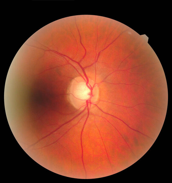 Human eye anatomy taking images with Mydriatic Retinal cameras. Examination of the eye, diabetic retinopathy, ARMD