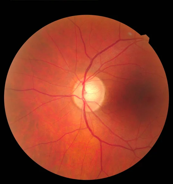 Анатомия глаза человека, делающая снимки с помощью камер Mydriatic Retinal. Обследование глаза, диабетическая ретинопатия, АРМД — стоковое фото