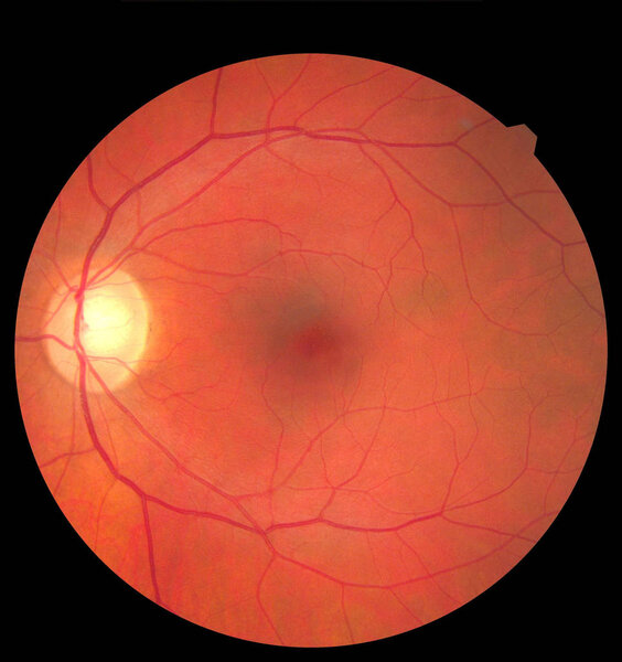 Human eye anatomy taking images with Mydriatic Retinal cameras. Examination of the eye, diabetic retinopathy, ARMD