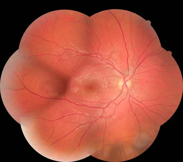 Медична фотографія діабетичної ретинопатії сітківки. Огляд ока, діабетична ретинопатія, АРМД — стокове фото