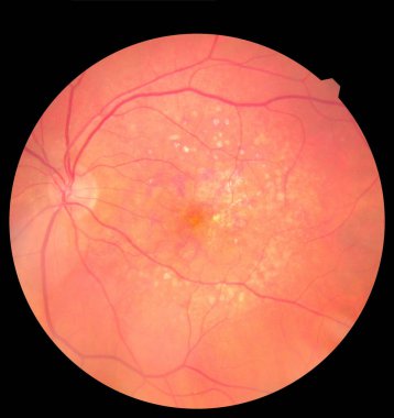Göz altı görüntüsü retina ve optik sinirleri sağlıklı bir insan gözünün içinde detaylandırıyor. Sağlık koruma kavramı