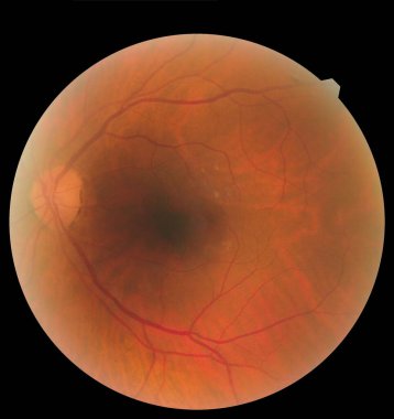 Göz altı görüntüsü retina ve optik sinirleri sağlıklı bir insan gözünün içinde detaylandırıyor. Sağlık koruma kavramı