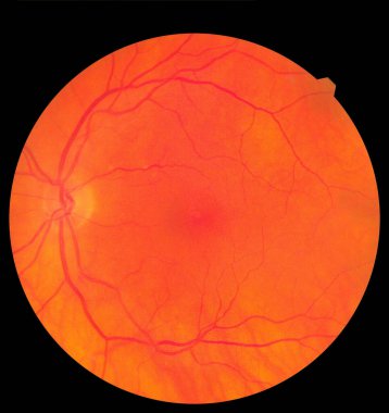 Göz altı görüntüsü retina ve optik sinirleri sağlıklı bir insan gözünün içinde detaylandırıyor. Tıp konsepti