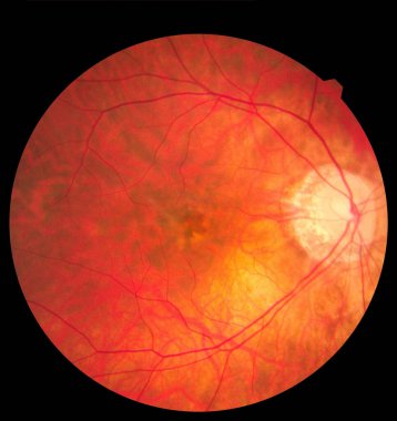 Göz altı görüntüsü retina ve optik sinirleri sağlıklı bir insan gözünün içinde detaylandırıyor. Tıp konsepti