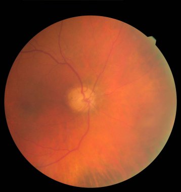 Göz altı görüntüsü retina ve optik sinirleri sağlıklı bir insan gözünün içinde detaylandırıyor. Tıp konsepti