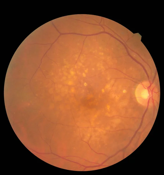 건강 한 사람의 눈 안에 있는 망막 과 시신경을 세밀하게 묘사하는 마이크 로 영상. 건강 보호 개념 — 스톡 사진