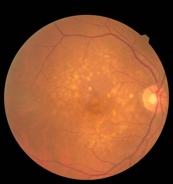 Ophthalmic image detailing the retina and optic nerve inside a healthy human eye. Health protection concept