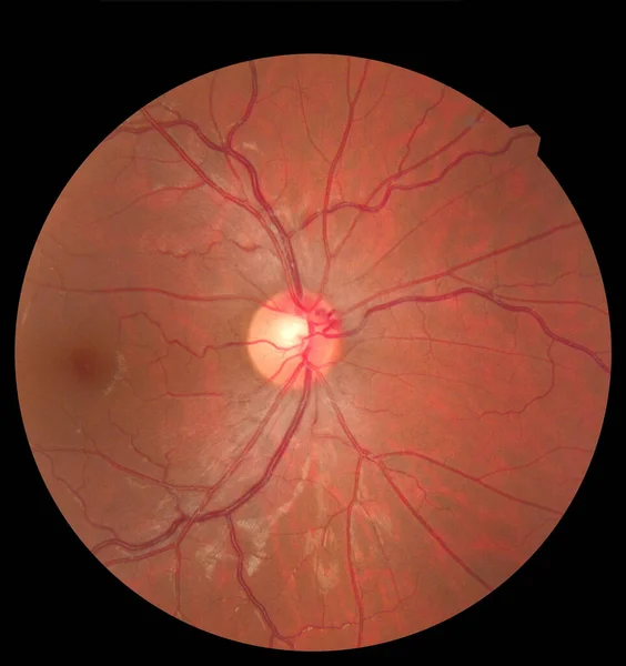 Imagen oftálmica que detalla la retina y el nervio óptico dentro de un ojo humano sano. Concepto de protección sanitaria — Foto de Stock