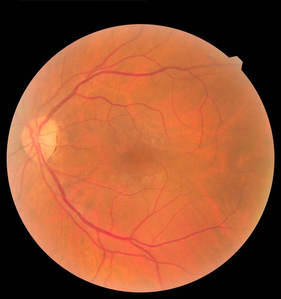 Ophthalmic image detailing the retina and optic nerve inside a healthy human eye. Health protection concept