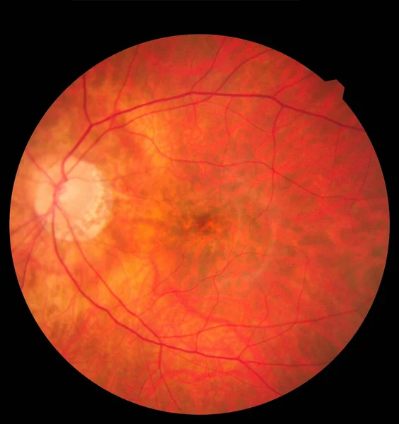Szemészeti kép, amely részletezi a retinát és a látóideget az egészséges emberi szem belsejében. Orvosi fogalom — Stock Fotó