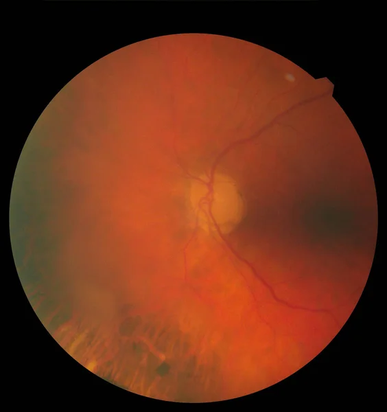 Imagen oftálmica que detalla la retina y el nervio óptico dentro de un ojo humano sano. Concepto de medicina — Foto de Stock