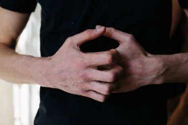 Ellerinde çatlak, pul pul deri var. Dermatolojik sedef hastalığı. Bir kadının parmaklarında sert ve çatlak bir deri var. El lekeleri, kuru cilt. Sedef hastalığı, alerji.