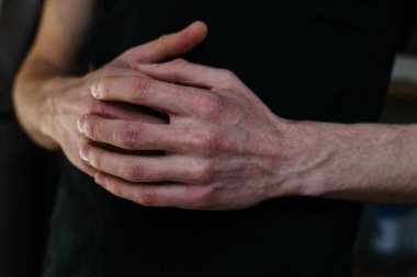 Ellerinde çatlak, pul pul deri var. Dermatolojik sedef hastalığı. Bir kadının parmaklarında sert ve çatlak bir deri var. El lekeleri, kuru cilt. Sedef hastalığı, alerji.