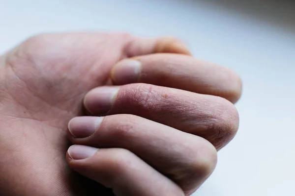 Homem com mãos doentes, pele seca escamosa na mão com psoríase vulgar, eczema e outras doenças de pele, como fungos, placas, erupções cutâneas e manchas. Doença genética auto-imune . — Fotografia de Stock