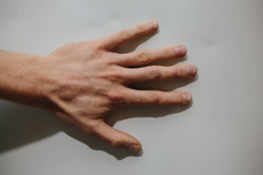 Sedef hastalığı derisi. Deriyi etkileyen bir otoimmün hastalıktır. Cilt iltihabına neden olur..