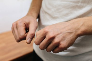 Sedef hastalığı derisi. Deriyi etkileyen bir otoimmün hastalıktır. Cilt iltihabına neden olur..