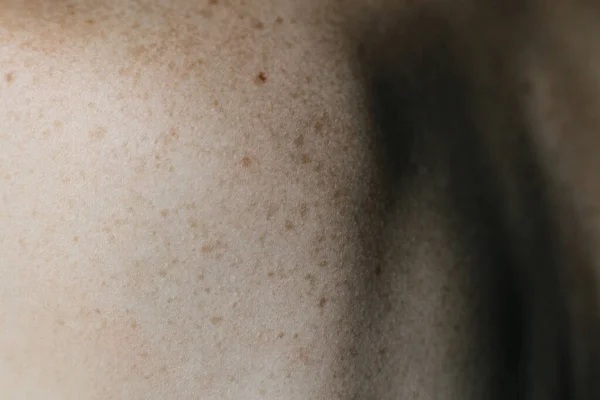 Kontroluji Neškodná Znaménka Detailní Detail Holé Kůže Zádech Muže Roztroušenými — Stock fotografie
