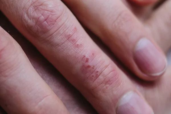乾いた皮膚の板を示す患者の指のクローズアップは 一般的に乾癬で見られます 皮膚の問題 — ストック写真