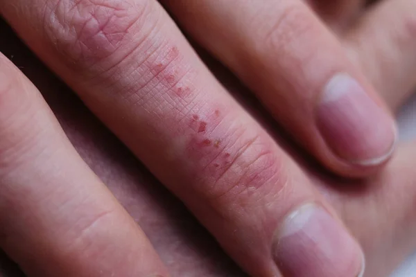 病人手指的特写 表现为典型的银屑病皮肤斑块 皮肤问题 — 图库照片