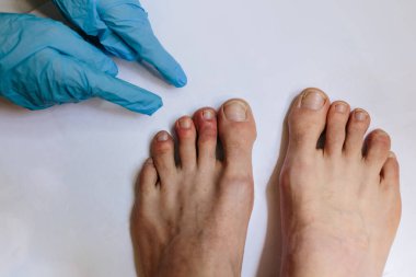 Mor, mavi ya da kırmızı ayak parmaklarında renk değişimine ve ara sıra da el ve ayak parmaklarında morluğa neden olan gizemli bir cilt durumu. Koronavirüs enfeksiyonunun yeni belirtileri. Covid 19