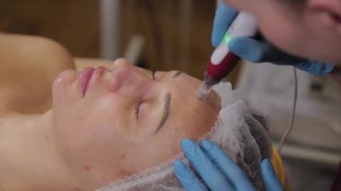 Professional beautician woman performs micronidling facial skin.