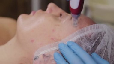 Professional beautician woman performs micronidling facial skin.