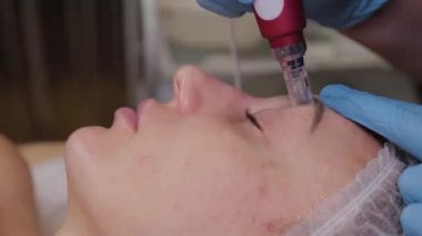 Professional beautician woman performs micronidling facial skin.