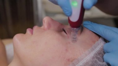 Professional beautician woman performs micronidling facial skin.