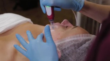 Professional beautician woman performs micronidling facial skin.