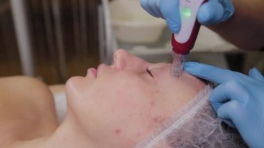 Professional beautician woman performs micronidling facial skin.
