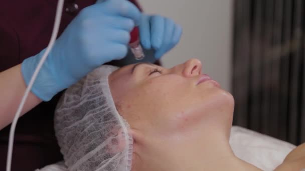 Επαγγελματική αισθητικός γυναίκα εκτελεί micronidling δέρμα προσώπου. — Αρχείο Βίντεο