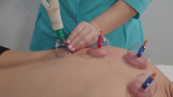 Лікар кладе вакуумні цілющі баночки на спину чоловіка . — стокове відео