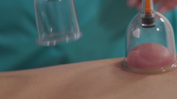 Le médecin met des canettes de guérison sous vide sur le dos d'un homme . — Video