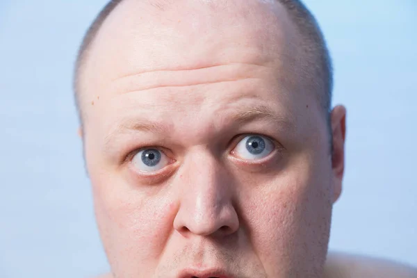 Retrato de um homem careca que abaulou os olhos . — Fotografia de Stock