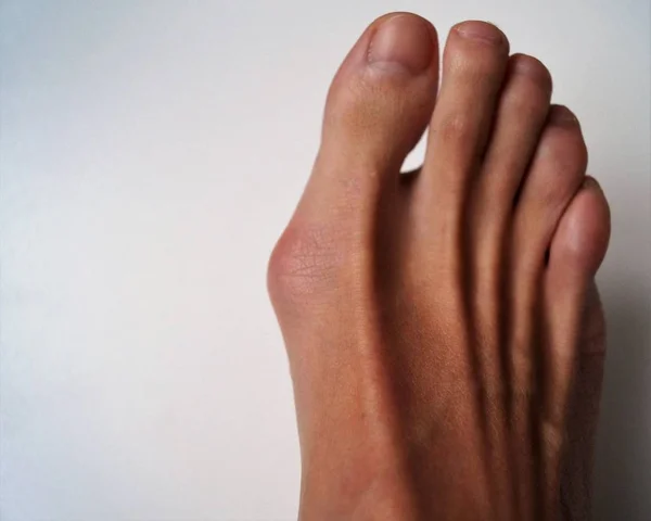 Bump Big Toe Man Physiological Health Problem Stock Image