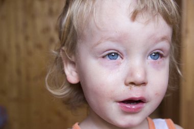 Sarı saçlı ve kırmızı gözleri hasta çocuk