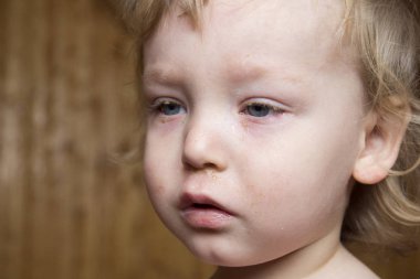 Küçük çocuk hasta konjonktivit üzerinden şişmiş kırmızı gözlü