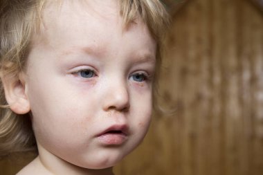 Konjonktivit üzerinden şiş gözler ile küçük hasta çocuk