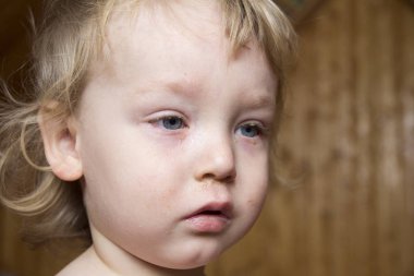 Sarı saçlı ve kırmızı gözleri hasta çocuk