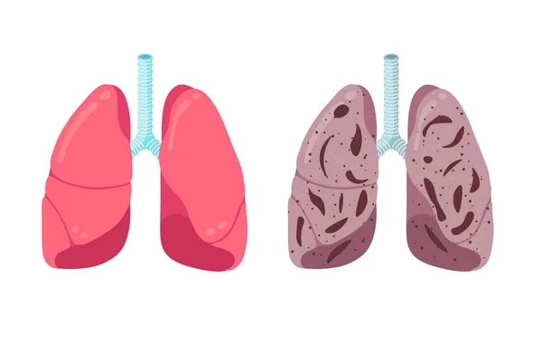 Los pulmones sanos y poco saludables comparan el concepto. Sistema respiratorio humano órgano interno fuerte y neumonía inflamación. Salud respiración anatomía médica vector ilustración — Archivo Imágenes Vectoriales