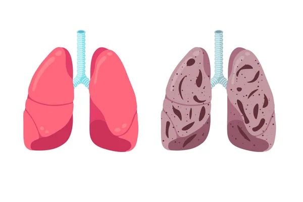 Sağlıklı ve sağlıksız akciğerler kavramı karşılaştırır. İnsan solunum sistemi iç organı güçlü ve zatürree iltihabı. Sağlık hizmeti solunumu tıbbi anatomi vektörü çizimi — Stok Vektör