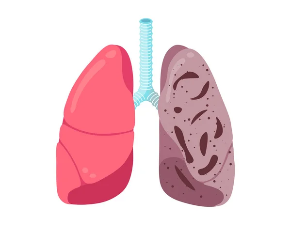 Больной нездоровый туберкулёз легких. Внутренняя часть органов дыхания человека поражена туберкулезной палочкой или пневмонией. Иллюстрирование вектора повреждений медицинской анатомии — стоковый вектор