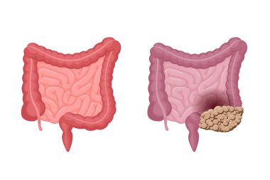 Bağırsak anatomisi güçlü, sağlıklı ve kolon kanseri karşılaştırmasıyla sağlıksız. Karın boşluğu sindirim ve dışkısal iç organ onkoloji tümörü. Vektör sindirim sorunu illüstrasyon yaratır