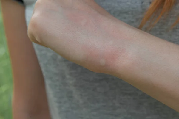 Insectenbeet, mug, teek. Irritatie. Het meisje krassen haar arm. Stockafbeelding