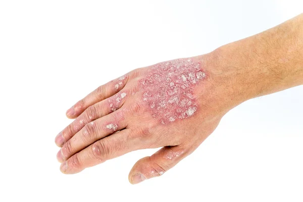 Psoriasis บนมือที่แยกจากสีขาว — ภาพถ่ายสต็อก