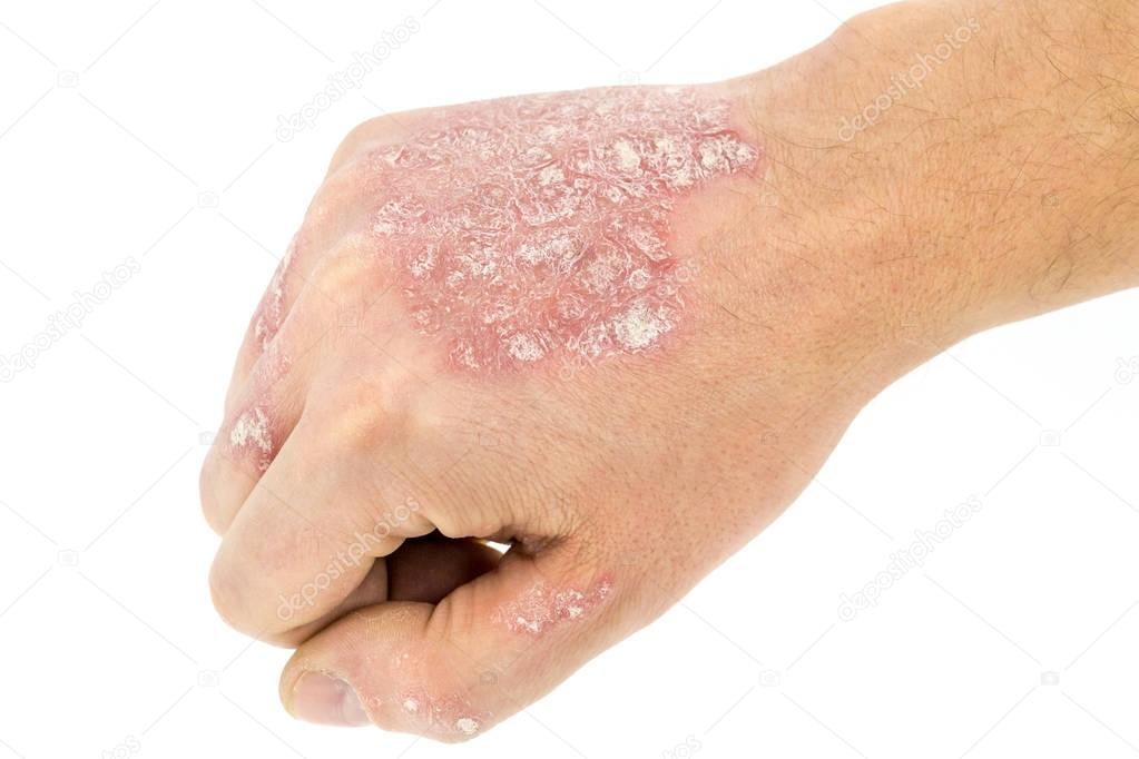 Psoriasis sur la main isolée sur blanc — Photographie 2Ban © #136268260