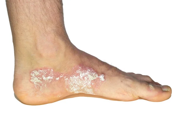 Psoriasis på fot isolerad på vit bakgrund — Stockfoto