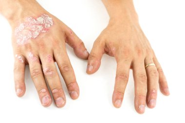 Psoriasis vulgaris üzerinde eller mans