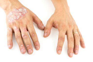 Psoriasis vulgaris on the mans hands clipart
